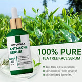 UPTOWN LA Anti Acne Serum 30ml ,Pimple Remove Serum, Dark Spot Remover, Acne Scar Serum, Oil Control Serum, Blackhead Remover Serum, Glowing Skin Serum, Whitening Acne Serum, Best Serum for Pimples, Oily Skin Care Serum, Face Serum for Men, Face Serum