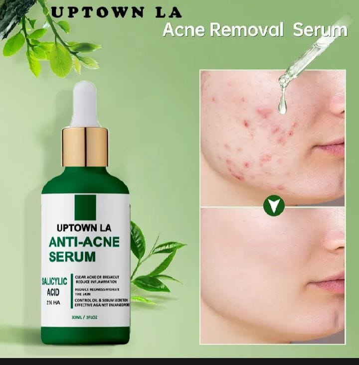UPTOWN LA Anti Acne Serum 30ml ,Pimple Remove Serum, Dark Spot Remover, Acne Scar Serum, Oil Control Serum, Blackhead Remover Serum, Glowing Skin Serum, Whitening Acne Serum, Best Serum for Pimples, Oily Skin Care Serum, Face Serum for Men, Face Serum