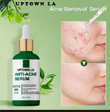 UPTOWN LA Anti Acne Serum 30ml ,Pimple Remove Serum, Dark Spot Remover, Acne Scar Serum, Oil Control Serum, Blackhead Remover Serum, Glowing Skin Serum, Whitening Acne Serum, Best Serum for Pimples, Oily Skin Care Serum, Face Serum for Men, Face Serum